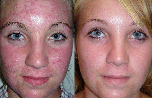 Как избавиться от прыщей на лице и улучшить состояние кожи - 100%